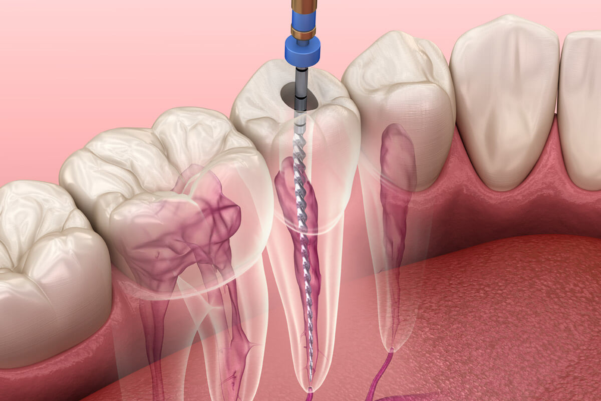 Endodonti - 1