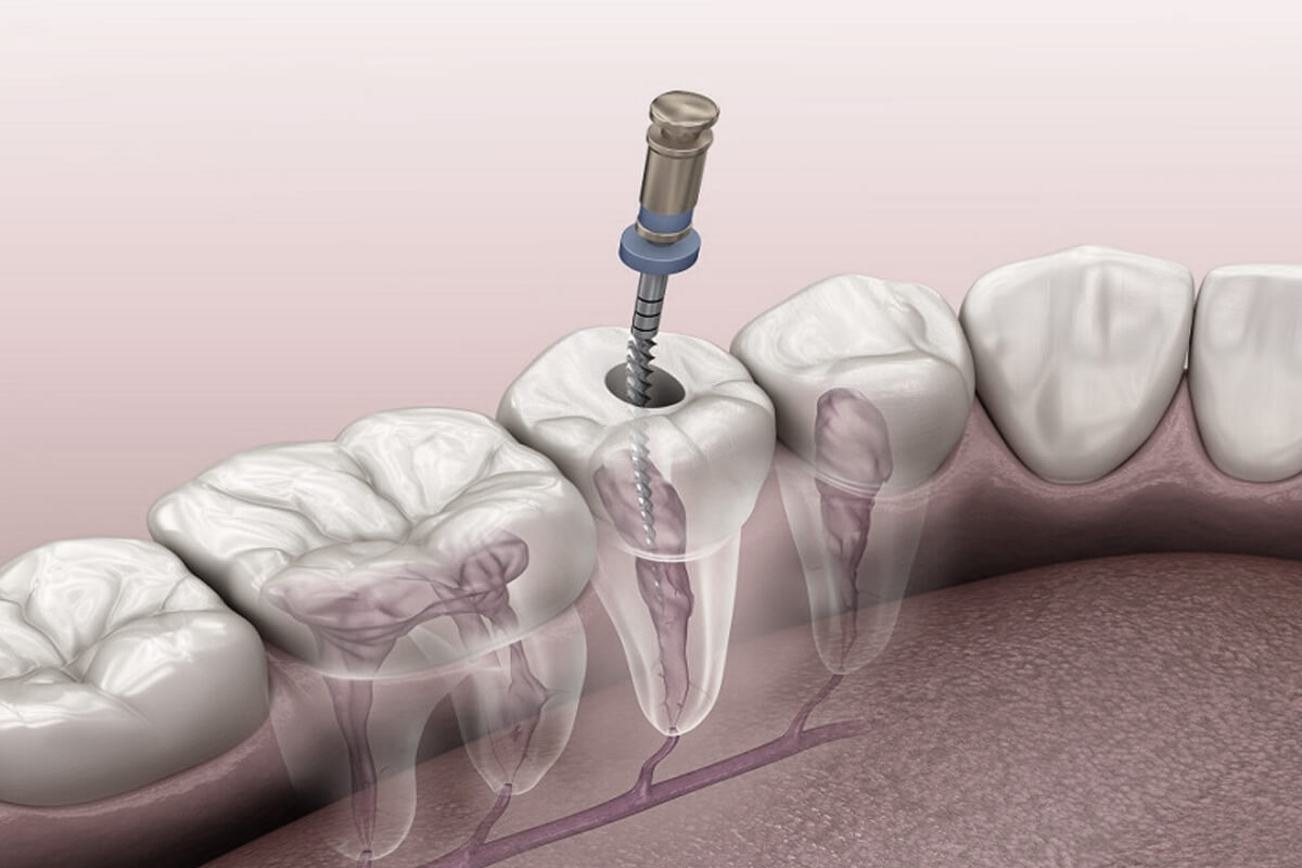 Endodonti - 2
